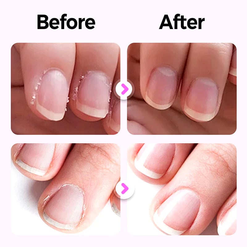 đSpeciellt för manikyr â nagelvĂ„rdspenna, reparerar nagelskador orsakade av manikyr